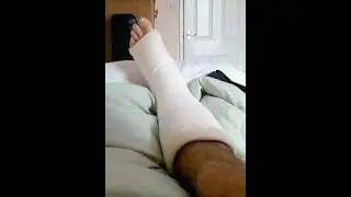 🔴Broke my Leg But I'll play | Fun Gameplay #ragedlive