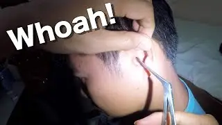 Huge Foreign Body Stuck In Man's Ear Removed | What is it?