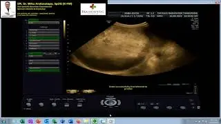 CA OVARIUM - TUMOR PADAT OVARIUM MALIGNA (Dr Wiku Andonotopo)