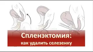 Спленэктомия: как удалить селезенку