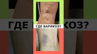 ГДЕ ВАРИКОЗ?