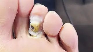 Pedicure tutorial：treatment of plantar warts, super decompression 【pedicure master Lin Jun】