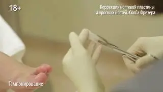 Коррекция деформации ногтевой пластины. Процедура установки индивидуальной скобы Фрезера в GMTClinic