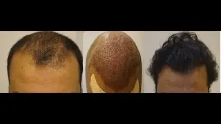 3000 Grafts BIO FUE Hair Transplant Surgery Result Before After, India