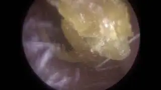 Ear Wax Removal and Dead Skin Removal using Endoscopic Microsuction -  