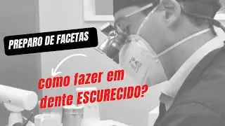 Preparo faceta dente escurecido - laminado direto