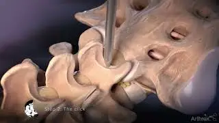 Interlaminar Approach for Discectomy Procedures