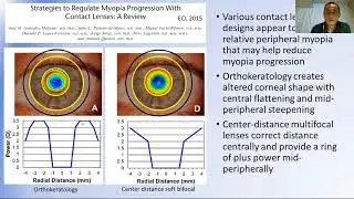 Orthokeratology Lenses: Addressing Myopic Refractive Error and Progression