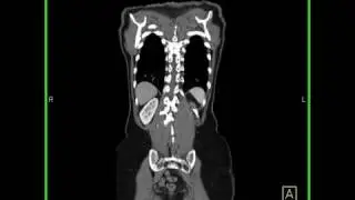 Miscellaneous:Whole body study:Whole body CT scan view as interactive display in the coronal plane.