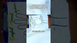 Carpal tunnel syndrome 
