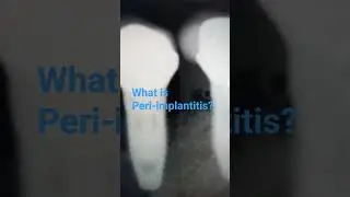 What is Peri-implantitis ? 