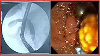 ERCP Stone Extraction l ERCP l ইআরসিপি l  ইআরসিপি করে পাথর বের করা #BD_ENDOSCOPY