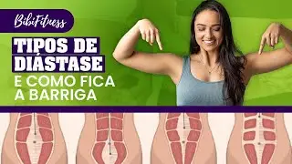 Tipos de diástase e como fica a barriga (estômago alto, pochete, barriga de grávida) #diastase