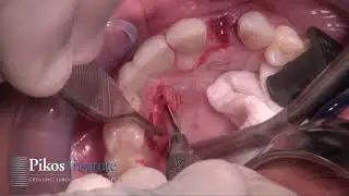 Step by Step Video: Extraction Socket Graft with Connective Tissue Graft