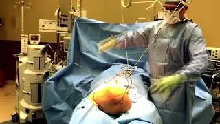 Medial Thigh Panniculectomy for Lymphedema