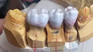 How to Make 3 Unit Lower Posterior Bridge
