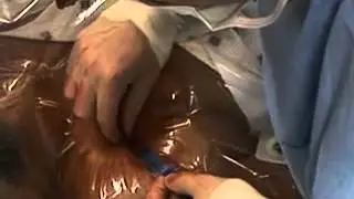 Central Venous Catheterization — Subclavian Vein NEJM
