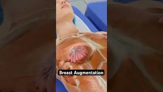 Breast augmentation (3D Animation)