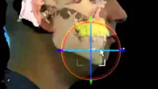 3-D Virtual Jaw Surgery Demonstration