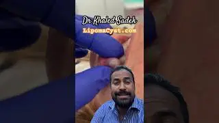Mucocele explained Dr Khaled Sadek 