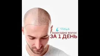 Пересадка волос в Алматы. от А до Я Без рубцов и шрамов. месяцев после пересадки.