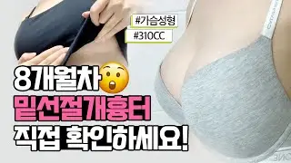 밑선절개도 미고💖 세빈인테그리티 가슴성형 8개월차 촉감&밑선절개 흉터는?! | Migo Plastic Surgery 미고성형외과Breast augmentation Review