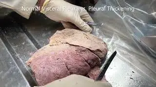 LOBAR PNEUMONIC CONSOLIDATION – Red Hepatized Lungs with Pleural Thickening – Sanjoy Sanyal