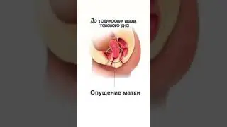 Callibri BeFit поможет устранить проблему с опущением матки