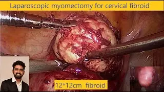 Laparoscopic myomectomy for isthmo-cervical fibroid using v-lock sutures..