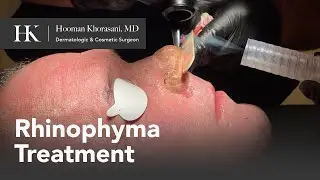 CO2 Laser Skin Resurfacing for Rhinophyma Treatment | Dr. Hooman Khorasani