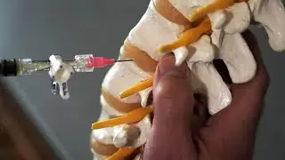 Two-step method patches herniated discs