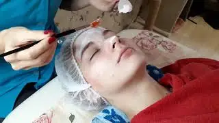 Эксфолиация, массаж лица и нанесение азелаинового пилинга