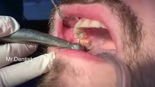 Tooth Preparation For Crowns !!!!!
