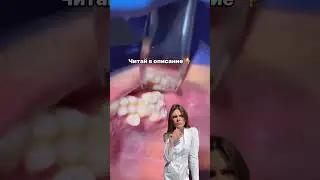 до 60% смотрящих это видео, имеют гипердонтию или сверхкомплентные зубы. Читай описание #здоровье