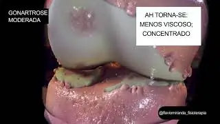 ARTROSE DE JOELHO / GONARTROSE