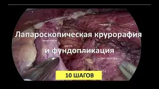 Лапароскопическая крурорафия и фундопликация по Ниссену: 10 шагов.