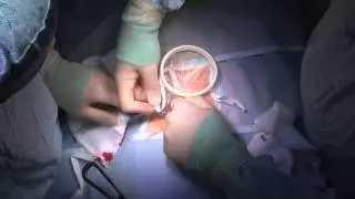 Trephine Defunctioning Loop Ileostomy using an ALEXIS Wound Protector