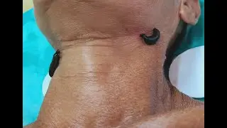 Лечение заболеваний щитовидной железы.  Узловой зоб и гормоны.