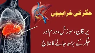 Hepatitis ka asan ilaj | Jigar ko theek krne ki desi dawa