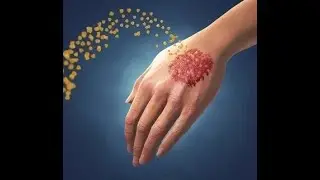Псориаз Медитативная практика исцеления