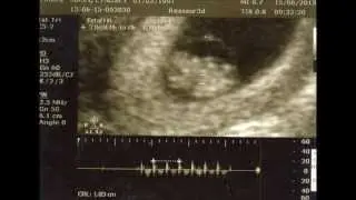 Our babys heartbeat at 11 weeks 3 days using a fetal doppler at home!