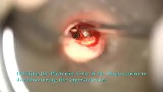 Artz - Laser Stapedotomy Surgery