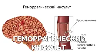 Геморрагический инсульт
