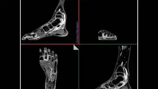 MSK Imaging – Arthiritis @ Siemens 3T Skyra