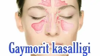 Gaymorit kasalligi_Гайморит касаллиги.