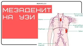 Мезаденит на УЗИ брюшной полости (увеличение лимфоузлов)