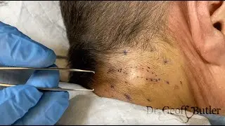 10 Year Old Neck Cyst Removed