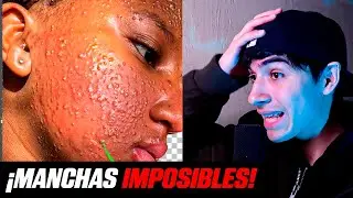 COMO QUITAR ACNE MOD PRO | Photoshop Tutorial