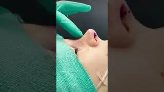 Does Rhinoplasty hurt? 