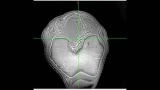 3D Dual-echo Ultra-short Echo Time MRI with Rosette k-Space Pattern